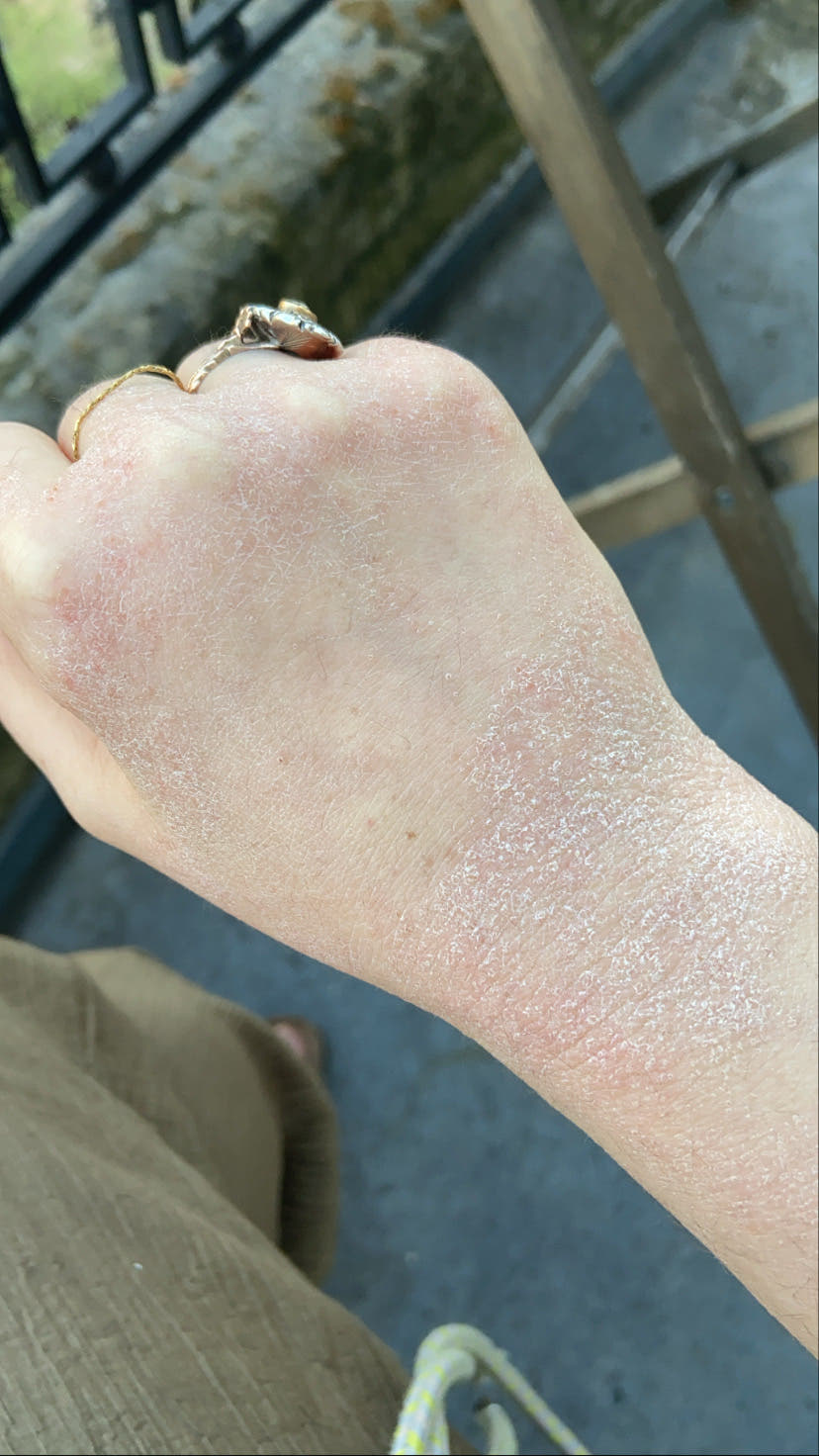 Eczéma chronique, peau sèche et rugueuse qui pèle sur la main, stade 3