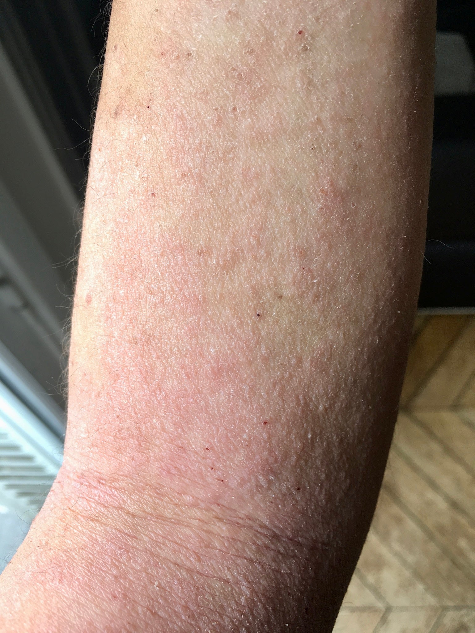peau rouge et sèche en deuxieme phase de l'eczema atopique
