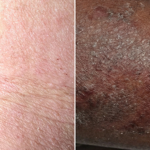 Peau rouge et sèche