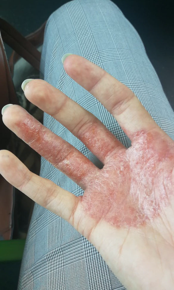 Main peau blanche avec eczéma
