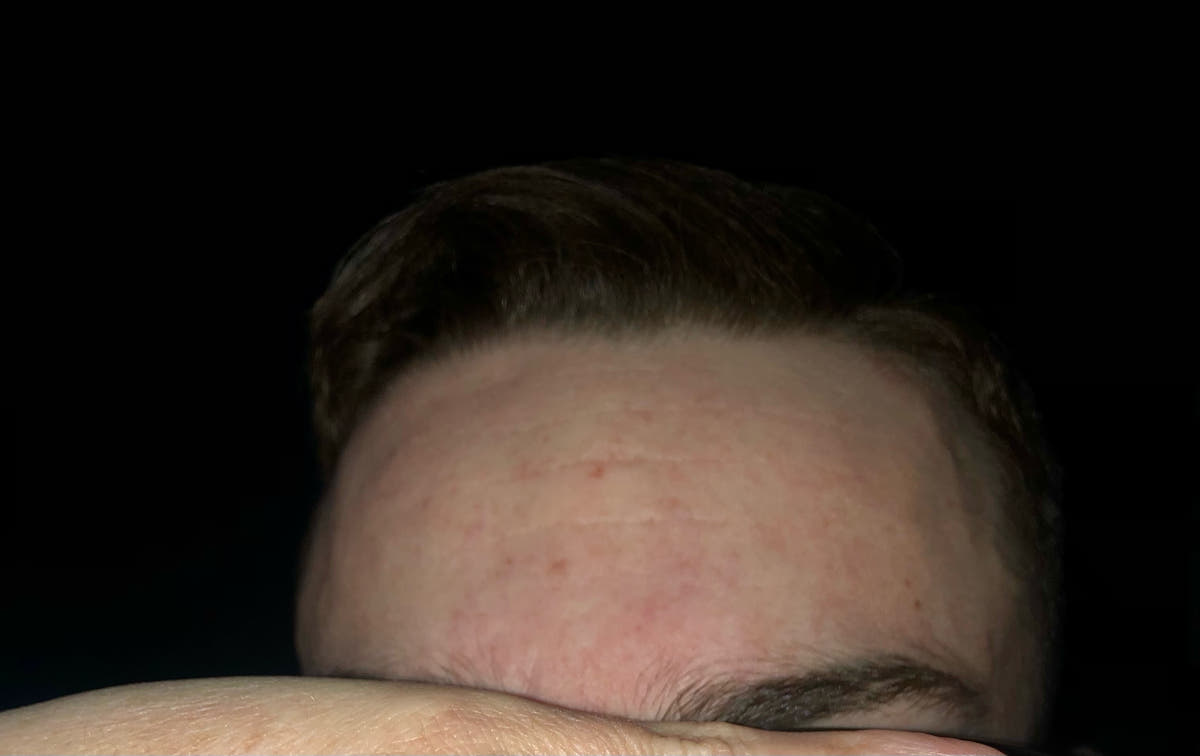 Peau de Hugo après Pomad